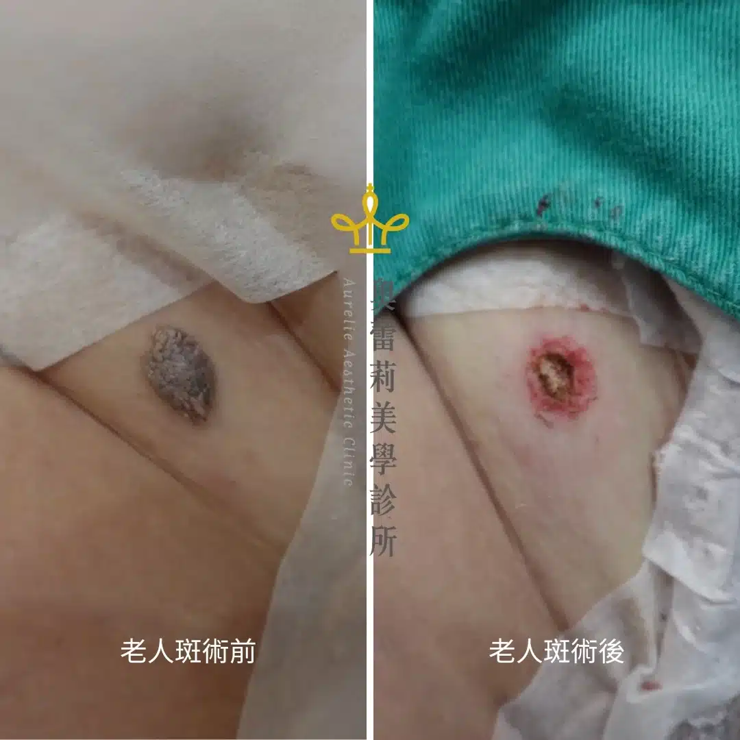 老人斑/肉芽/息肉 手術 