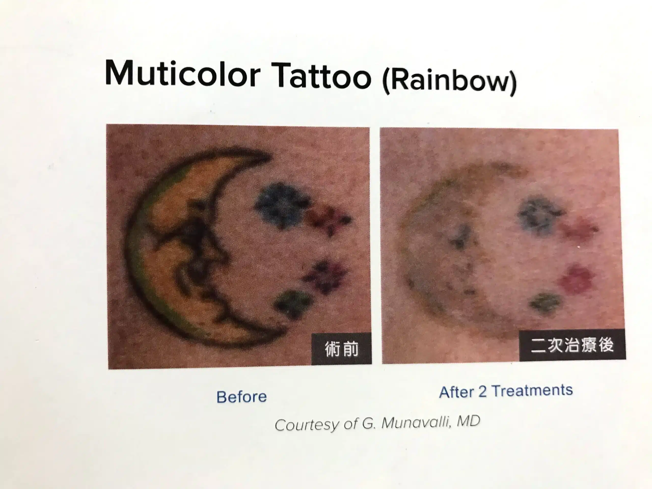 雷射除刺青效果-彩色
