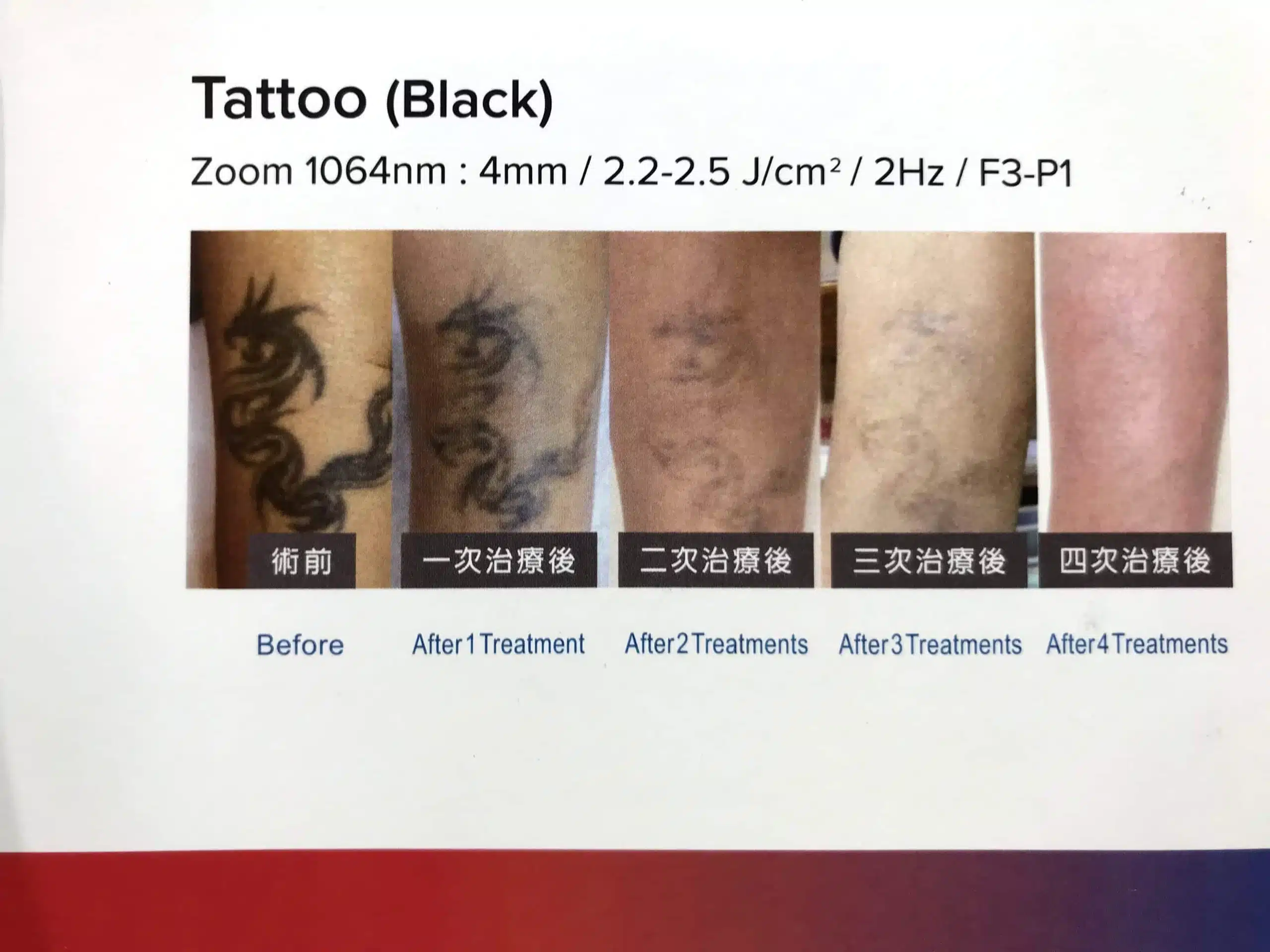 皮秒雷射除刺青效果-黑色刺青