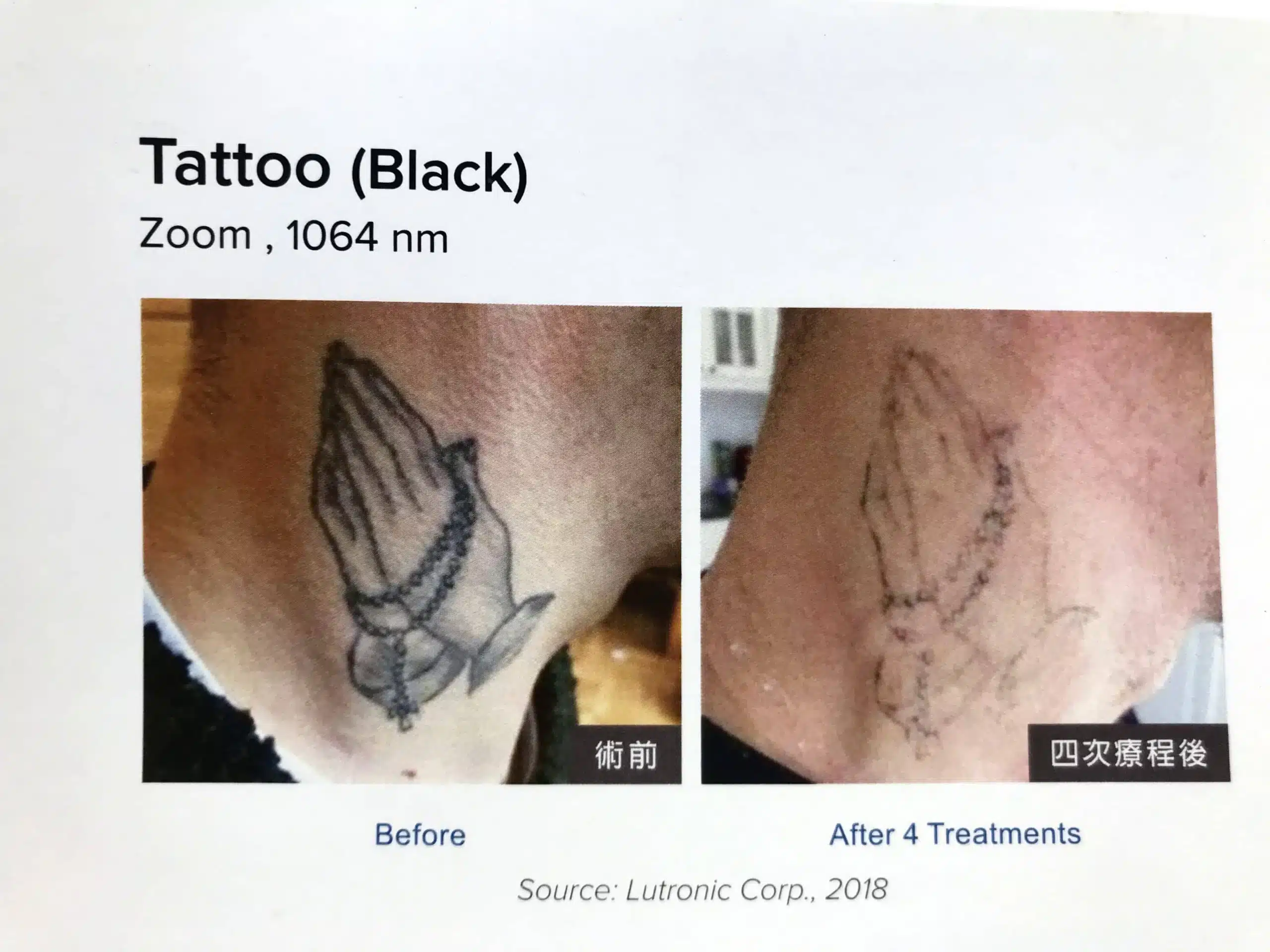 雷射除刺青效果-黑色