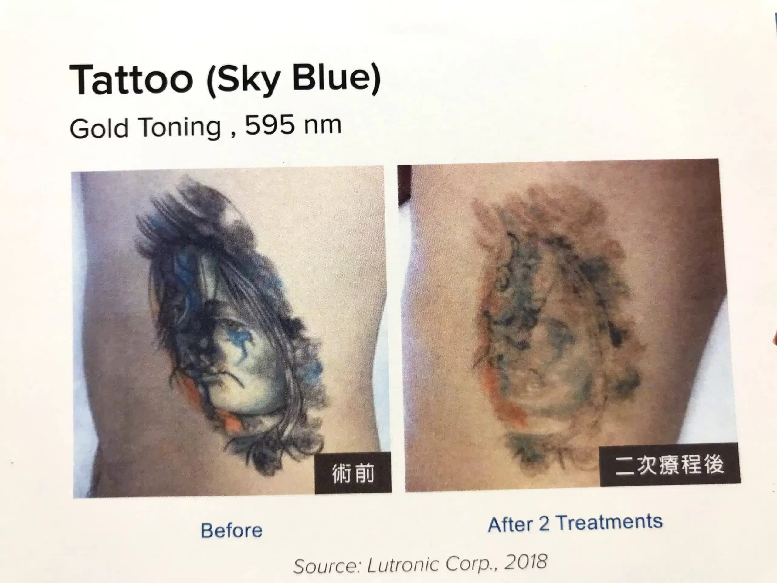 雷射除刺青效果-藍色