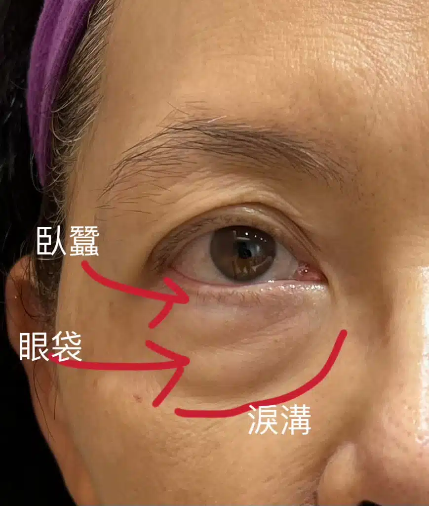 淚溝眼袋臥蠶的區別 difference between tear trough and eye bag