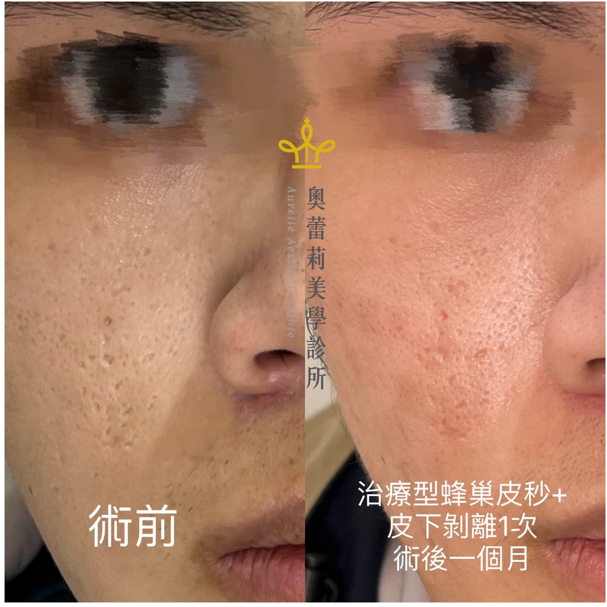 acne scar treatment subcision and picolaser before after
