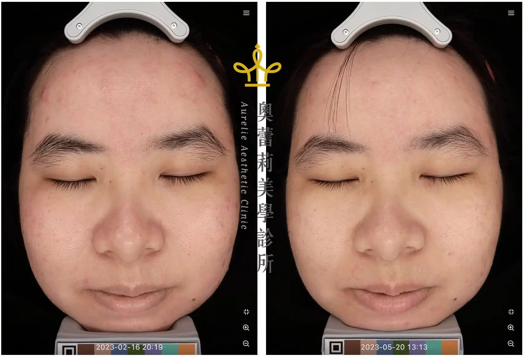 青春痘治療效果