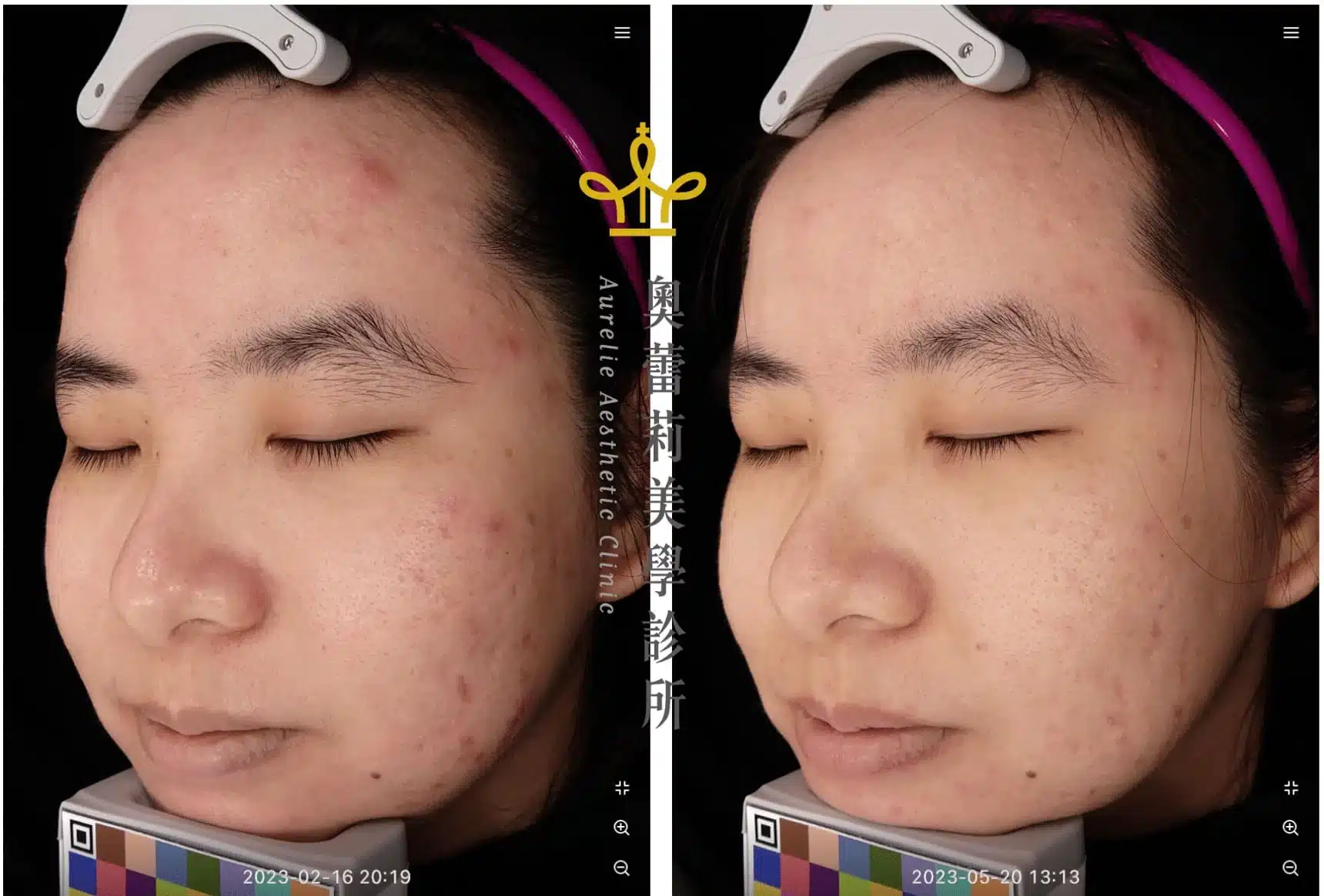 青春痘治療效果