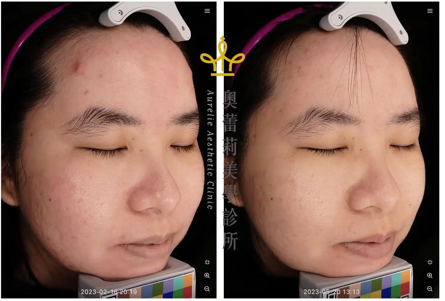 青春痘治療效果