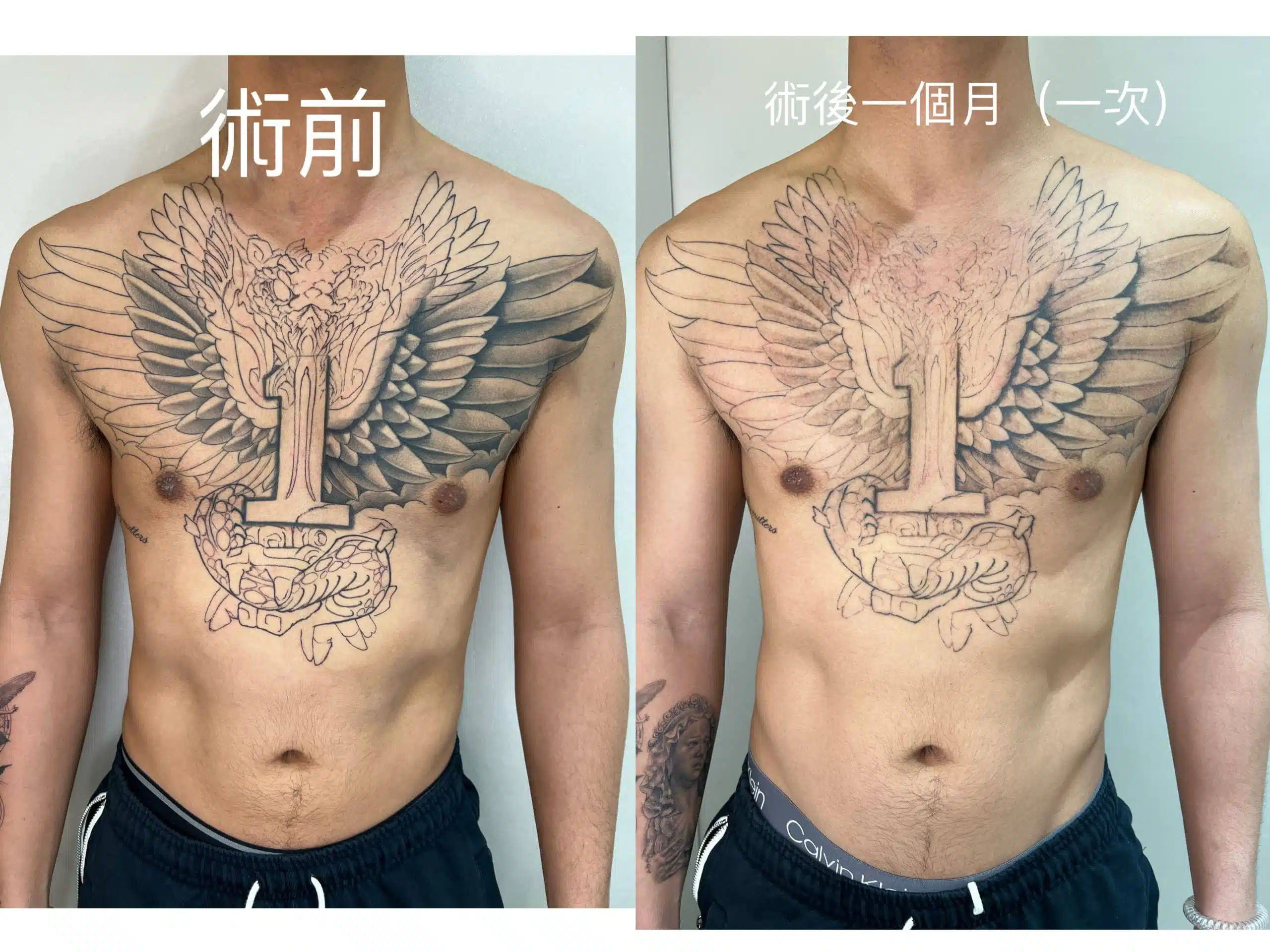 除刺青 身體大面積 BA圖