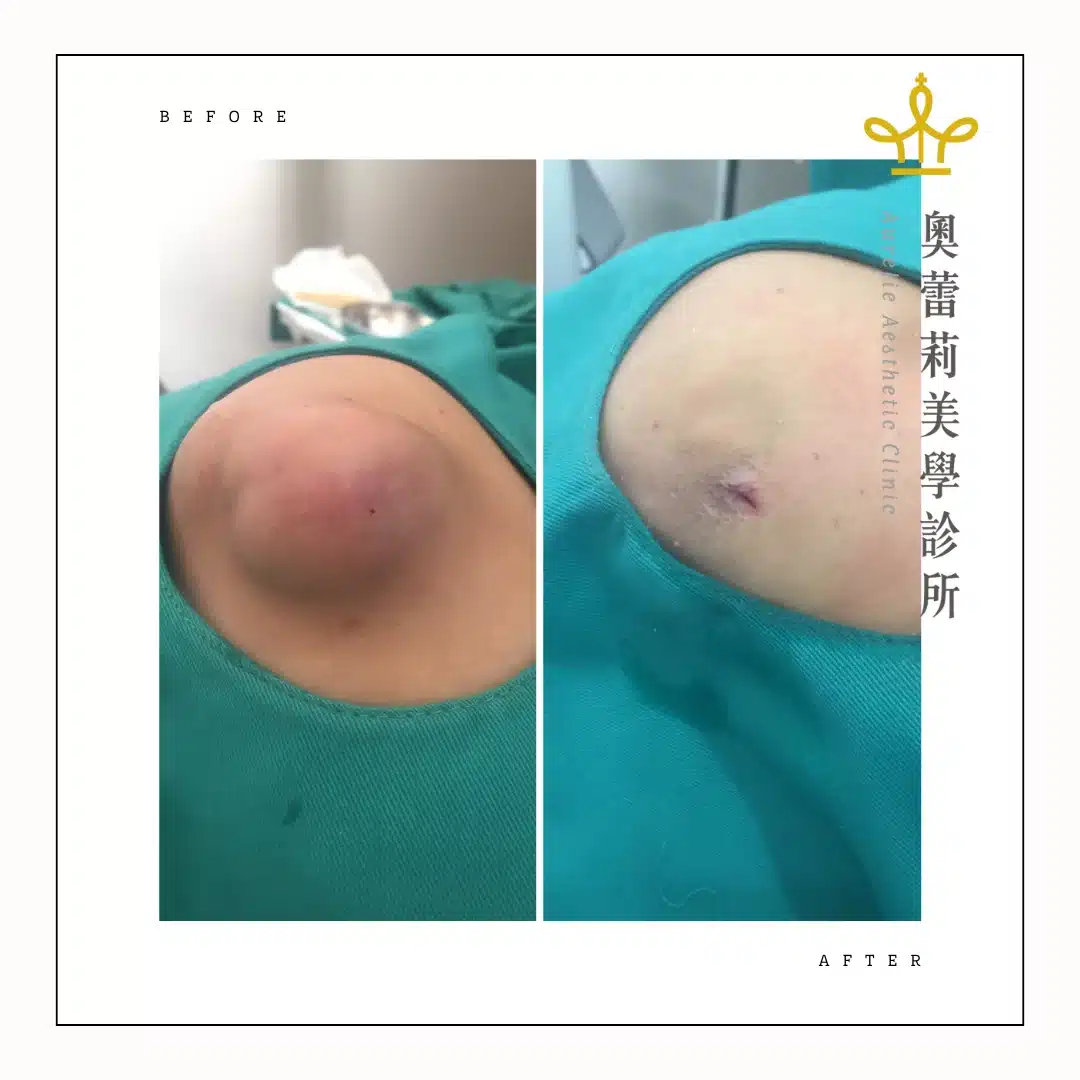 粉瘤 術前術後 epidermoid cyst before after