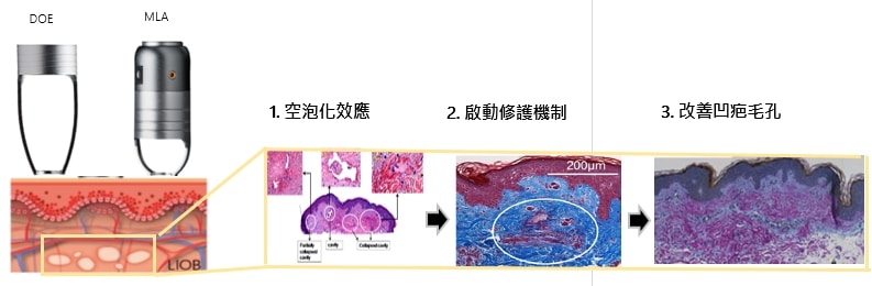 蜂巢皮秒是什麼？