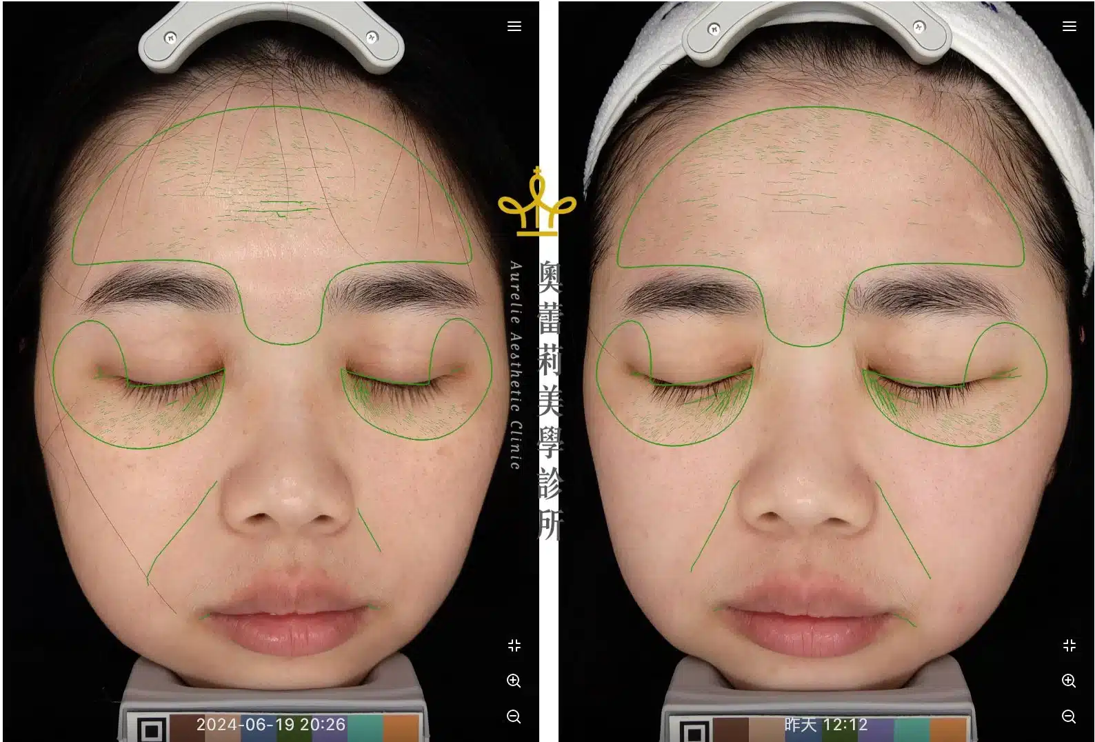 得美微針 額頭細紋 Dermapen4 forehead lines