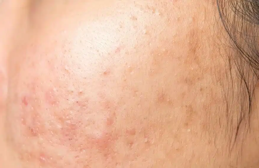 水飛梭推薦功效｜從清粉刺到改善膚質