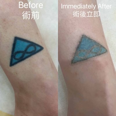 除刺青 藍色 術後立即 tattoo removal(blue)