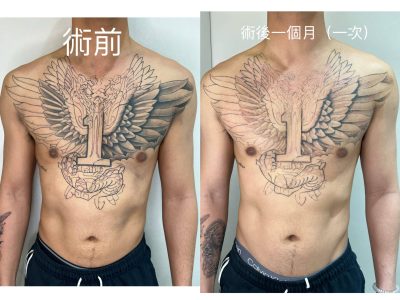 除刺青 身體大面積 BA圖