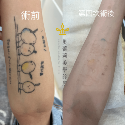 除刺青 術後4個月